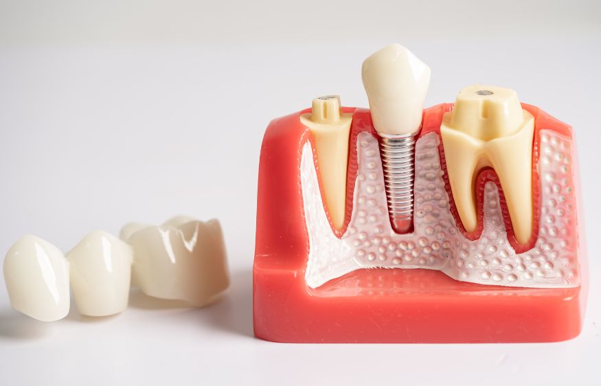 Root Canal Before Dental Crown